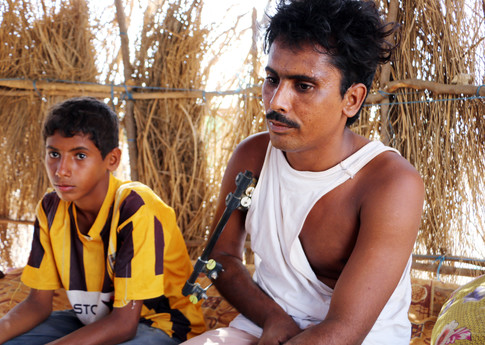 هندي إبراهيم، البالغ من العمر 25 عاماً ومن سكان قرية دغيج في مديرية حيران بمحافظة حجَّة، أحد ضحايا انفجار الذخائر الصغيرة. © Amnesty International