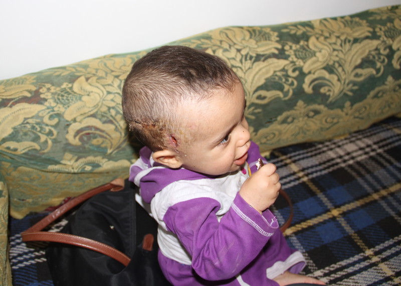 أصيب ابن فاطمة-  البالغ من و احد ونصف سنة-  في 30 مارس بقذيفة مضادة للطائرات ضربت منزلهم في سعوان، صنعاء