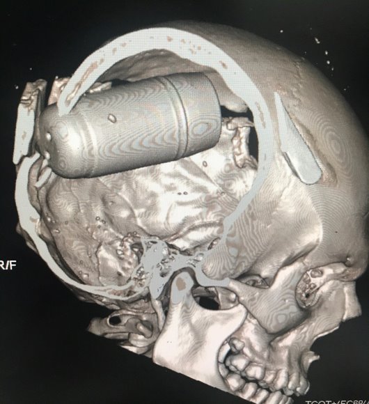 CAT scans shared with Amnesty International by medical professionals in Iraq show how tear gas grenades pierced protesters' skulls, causing horrific and fatal injuries amid protests in Baghdad in late October 2019. Credit: Private