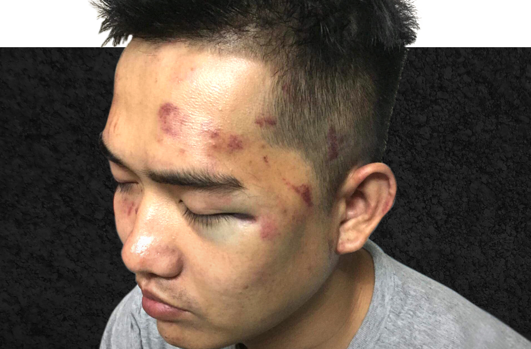 an activist from Vietnam after being severely beaten by police