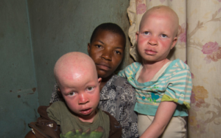 People with albinism in Malawi