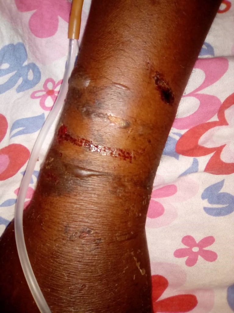 An Amnesty International analysis concluded that taken together, Ibrahima Sow's pattern of injuries strongly suggest the infliction of burns using a hot iron rod or a similar object.