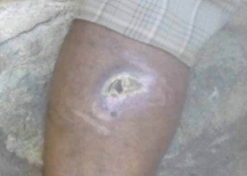 The healing wound on the back of Seyoum's leg after being beaten with wood and plastic sticks while in detention.