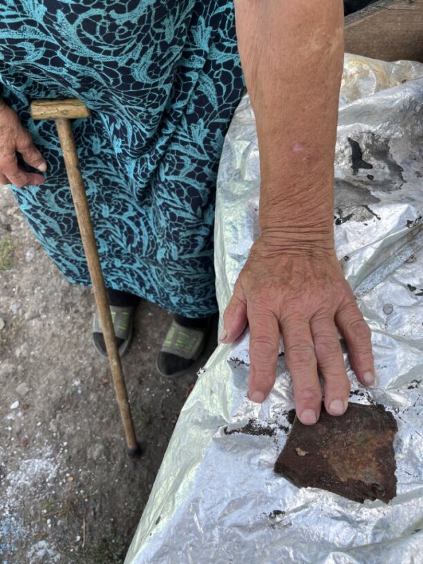 Woman's arm with scares and shrapnel under her hand.