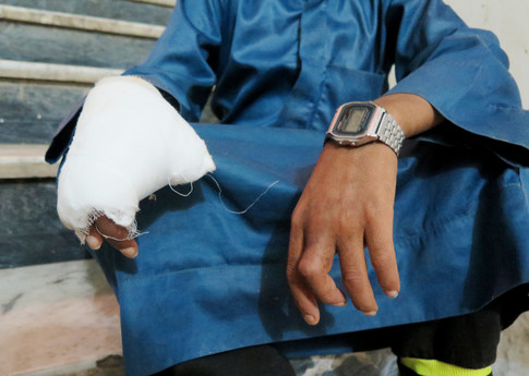 Niño de 11 años sobreviviente de un accidente provocado por una submunición que le amputó tres dedos y le rompió la mandíbula. Su hermano de ocho años murió en el acto. © Amnesty International