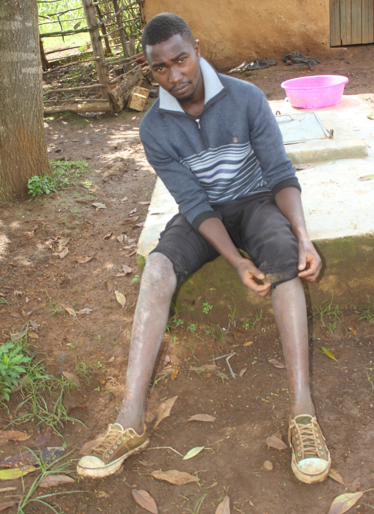 Philip Kimunya montre les traces des brûlures dont il a été victime lorsqu'il s'est échappé de l'église de Kiamba en flammes à Eldoret en 2007. ©Amnesty International